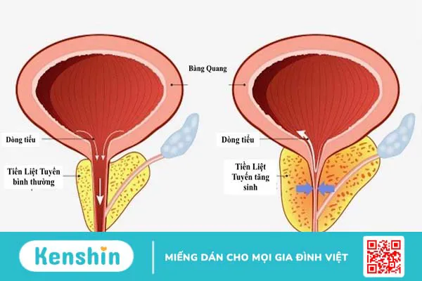 Những điều cần biết về tăng sản lành tính tuyến tiền liệt 1