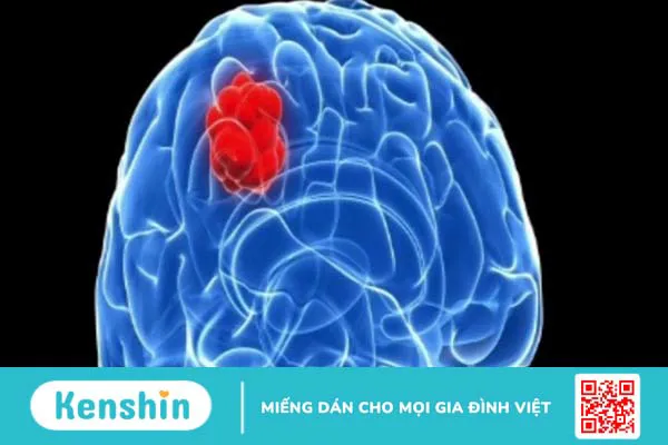 Những điều cần biết về u màng não lành tính