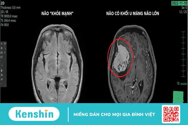 Những điều cần biết về u màng não lành tính 1