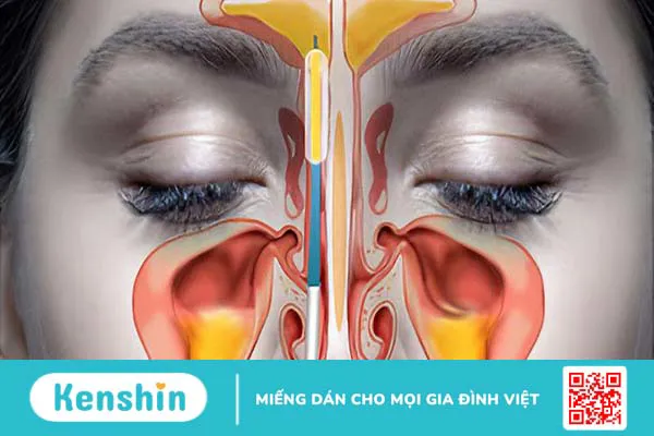 Những điều cần biết về viêm mũi xoang cấp và cách điều trị bệnh hiệu quả