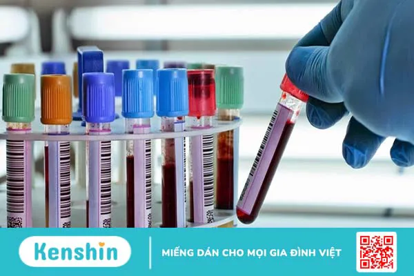 Những điều cần biết về xét nghiệm phosphatase kiềm 2