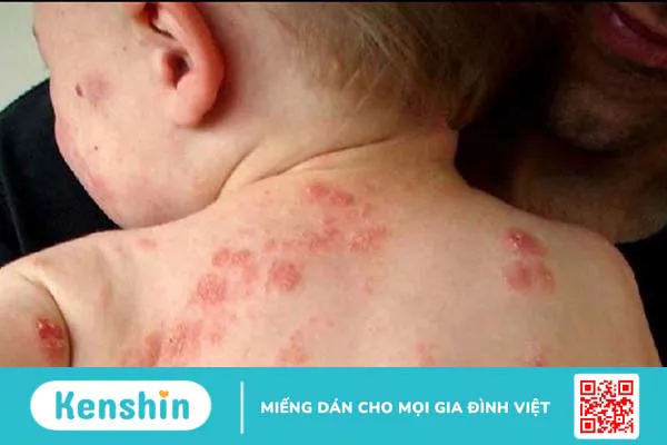 Những kinh nghiệm khi đi khám bệnh viện da liễu 1