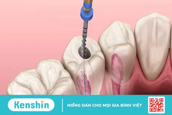 Những lưu ý khi chữa tủy răng số 6