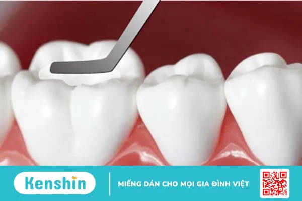 Những lưu ý khi chữa tủy răng số 6-1