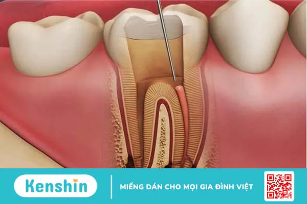 Những lưu ý khi chữa tủy răng số 6-2