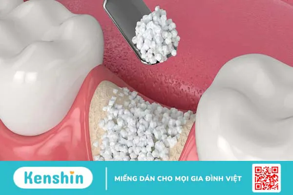 Những thông tin bạn cần nên biết về xương nhân tạo trong nha khoa