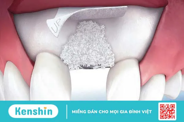 Những thông tin bạn cần nên biết về xương nhân tạo trong nha khoa