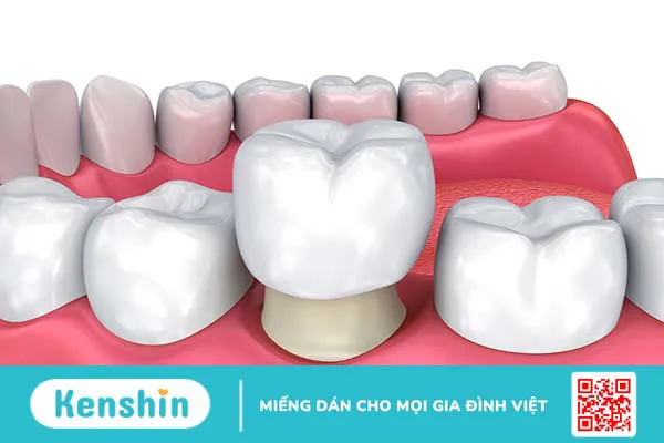 Những thông tin cần biết về bọc răng sứ lava esthetic 4