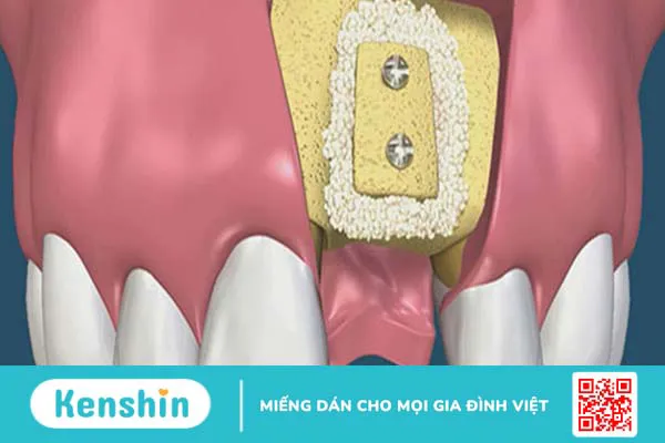 Những thông tin cần biết về kỹ thuật ghép xương răng