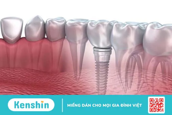 Những thông tin cần biết về kỹ thuật ghép xương răng