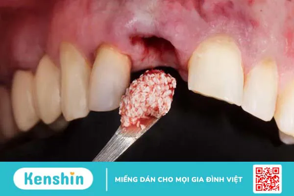 Những thông tin cần biết về kỹ thuật ghép xương răng