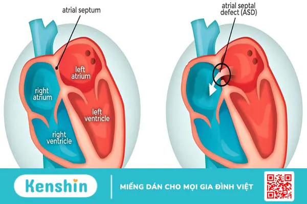 Những thông tin cần biết về vá lỗ thông liên nhĩ 2