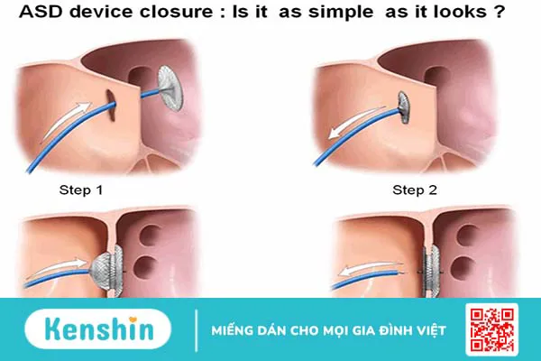 Những thông tin cần biết về vá lỗ thông liên nhĩ 3