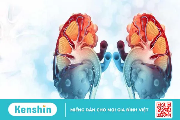 Những thông tin cơ bản về bệnh thận đa nang bẩm sinh không phải ai cũng biết 1