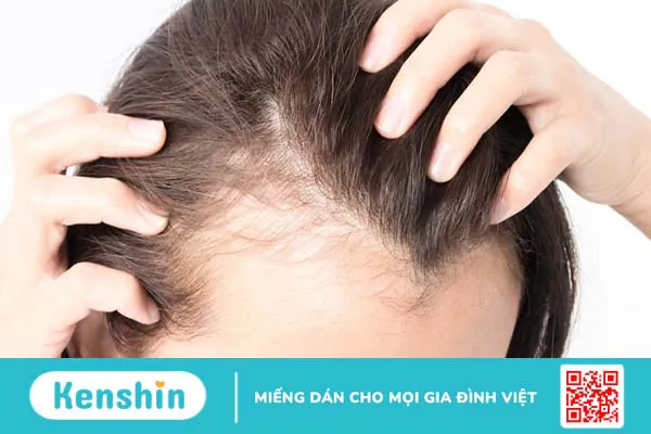 Những tinh chất chống gãy rụng giúp mẹ bầu sau sinh trị rụng tóc hiệu quả