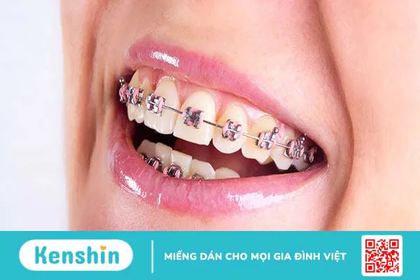 Những trường hợp nào nên thực hiện nắn chỉnh răng?