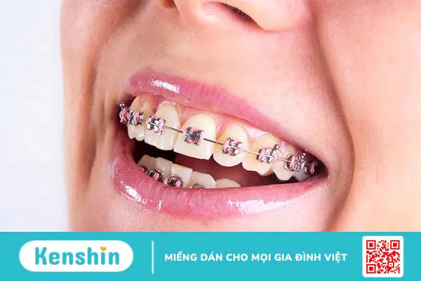 Những trường hợp nào nên thực hiện nắn chỉnh răng? 1