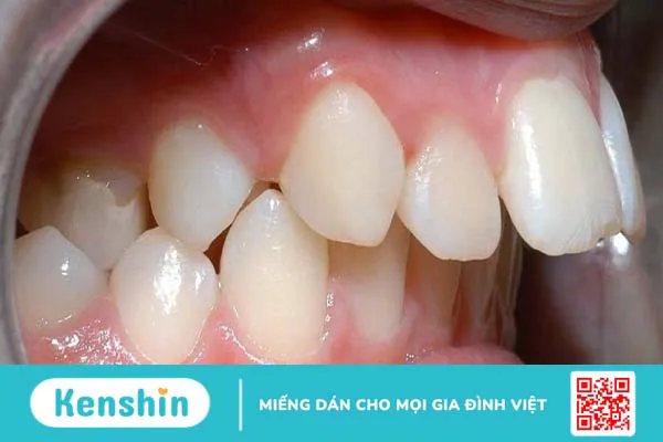 Những trường hợp nào nên thực hiện nắn chỉnh răng? 2