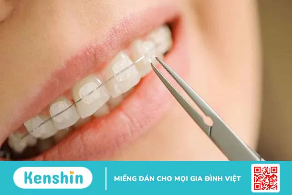 Niềng 2 răng cửa thưa được không? Nguyên nhân làm thưa răng cửa