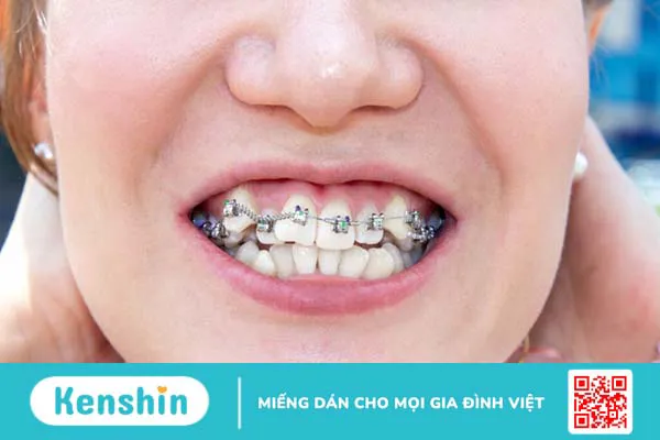 Niềng 2 răng cửa thưa được không? Nguyên nhân làm thưa răng cửa 4