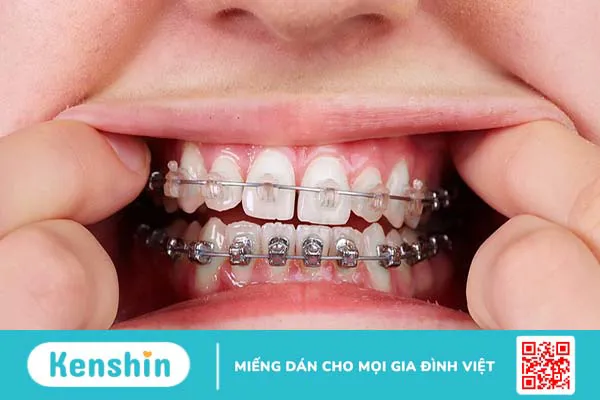 Niềng 2 răng cửa thưa được không? Nguyên nhân làm thưa răng cửa 5