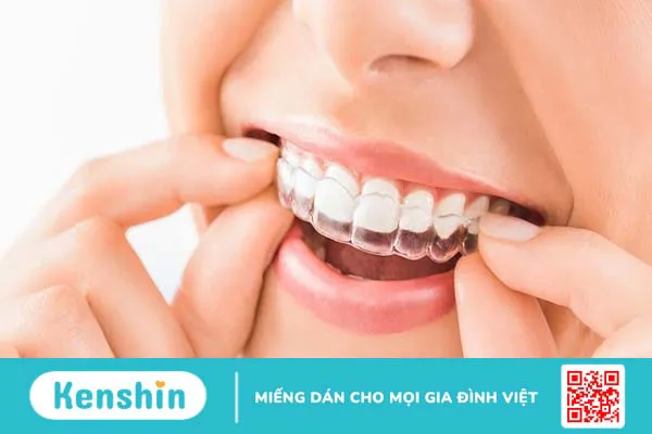 Niềng răng có được vĩnh viễn không? Các phương pháp niềng răng hiệu quả nhất