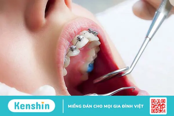 Niềng răng có được vĩnh viễn không? Các phương pháp niềng răng hiệu quả nhất