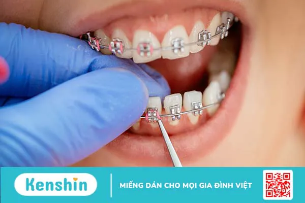 Niềng răng hỏng là gì? Dấu hiệu nhận biết niềng răng hỏng như thế nào?