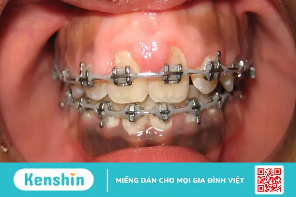 Niềng răng hỏng là gì? Dấu hiệu nhận biết niềng răng hỏng như thế nào?