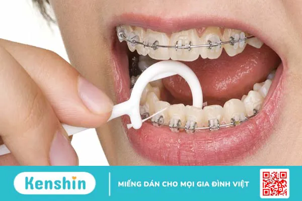 Niềng răng hỏng là gì? Dấu hiệu nhận biết niềng răng hỏng như thế nào?