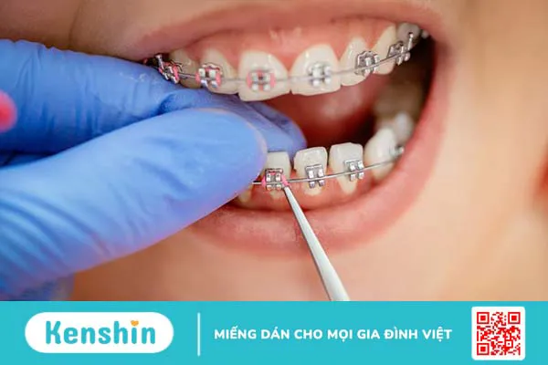 Niềng răng mắc cài 3M có mấy loại? Cần chú ý gì khi niềng răng?