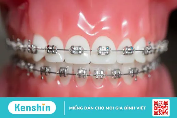 Niềng răng mắc cài 3M có mấy loại? Cần chú ý gì khi niềng răng?