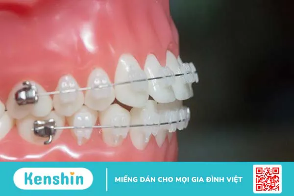 Niềng răng mắc cài 3M có mấy loại? Cần chú ý gì khi niềng răng?