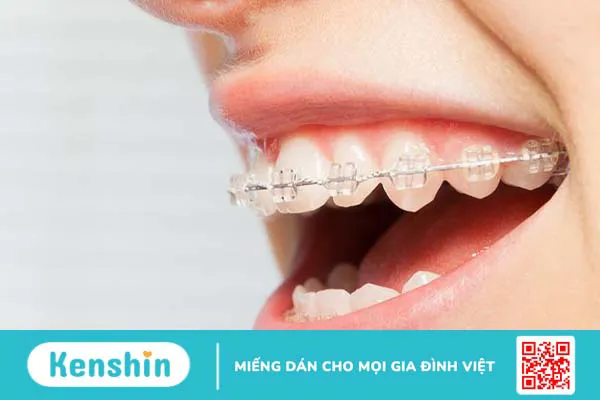 Niềng răng mắc cài sứ tự buộc: Ưu nhược điểm và báo giá chi tiết 1