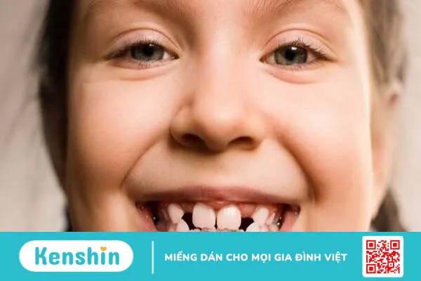 Niềng răng một hàm có được không? Những trường hợp có thể niềng răng một hàm?