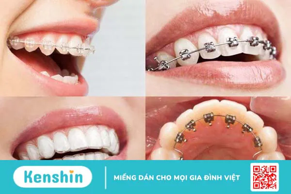 Niềng răng một hàm có được không? Những trường hợp có thể niềng răng một hàm?