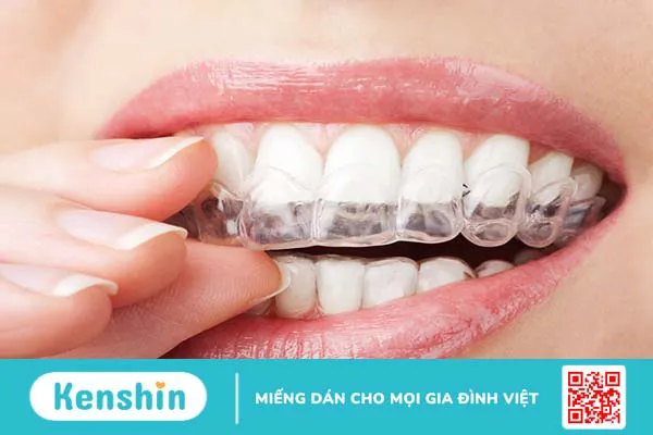 Niềng răng xong có bị hô lại không? Biện pháp ngăn ngừa tình trạng răng hô lại sau niềng răng