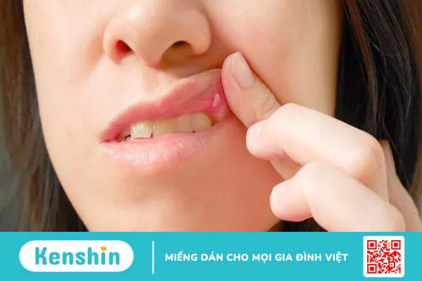 Nổi cục màu trắng trong miệng là bị bệnh gì?