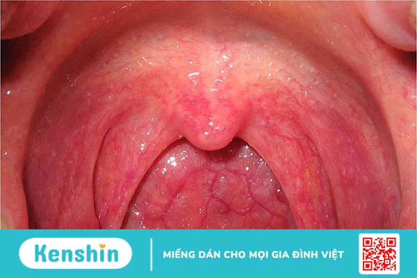 Nổi cục màu trắng trong miệng là bị bệnh gì?