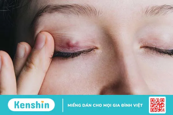 Nổi cục trong mí mắt là gì? Triệu chứng, nguyên nhân và phương pháp điều trị 2