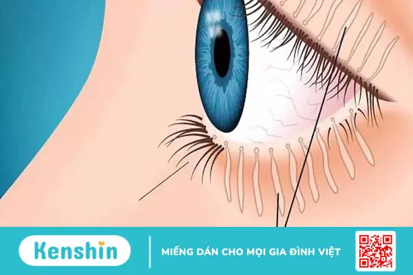 Nổi cục trong mí mắt là gì? Triệu chứng, nguyên nhân và phương pháp điều trị 3