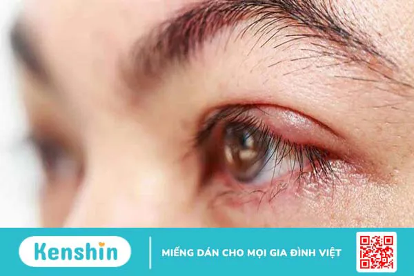 Nổi cục trong mí mắt là gì? Triệu chứng, nguyên nhân và phương pháp điều trị 4