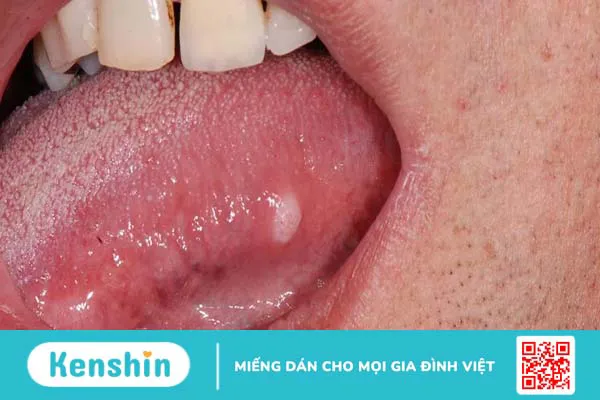 Nổi hạch dưới lưỡi có phải là dấu hiệu cảnh báo bệnh ung thư lưỡi không?