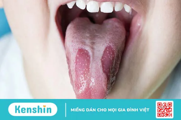 Nổi hạch dưới lưỡi có phải là dấu hiệu cảnh báo bệnh ung thư lưỡi không? 2