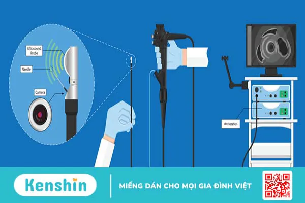 Nội soi siêu âm đường tiêu hóa trên: Để làm gì? Thực hiện như thế nào?