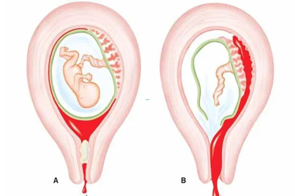 Nội xoay thai là gì? Quy trình kỹ thuật thực hiện nội xoay thai