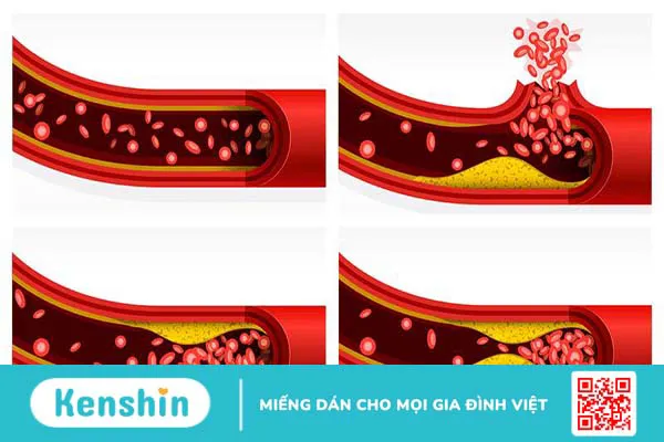 Non HDL cholesterol là gì và tầm quan trọng của nó đối với sức khỏe