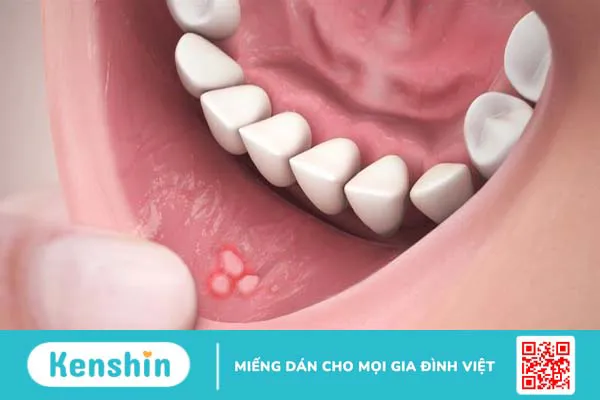 Nóng gan gây nhiệt miệng có nguy hiểm không? Các phương pháp chữa trị đơn giản tại nhà1