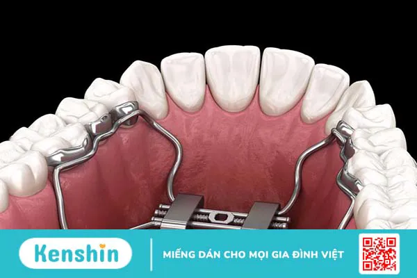 Nong hàm bằng dây cung và những điều bạn nên biết