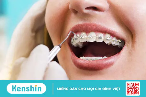 Nong hàm bằng dây cung và những điều bạn nên biết